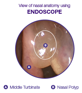 Graphic of view of nasal anatomy using an endoscope showing a nasal polyp in the middle turbinate