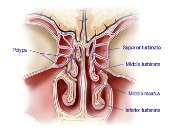 Graphic of nasal passages showing polyps, middle meatus location, and where the superior, middle, and inferior turbinates are located