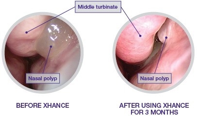 Image of nasal polyps before using XHANCE and after using XHANCE for 3 months
