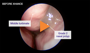 An example of a polyp reduction from grade 2 to grade 1.