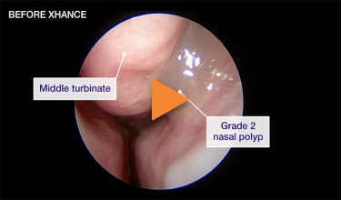 Patient 1 - reduction from grade 2 to grade 1