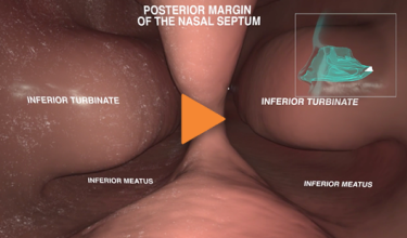 Follow along as medication delivered by XHANCE travels through the nasal anatomy.